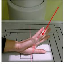 <p>Bennett’s fracture</p><p>Arm internally rotated, thumb flat on IR</p><p>15° proximal (toward wrist) to 1st CMC joint</p>