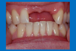 <p>What occlusion will you use for this patient?&nbsp;</p>