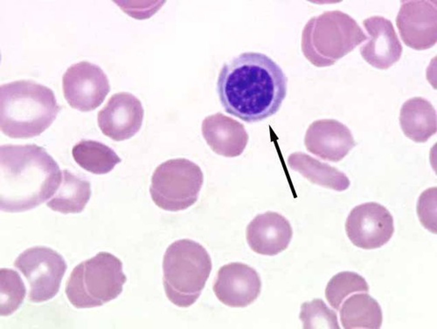 <p>Various anemias and normal newborn</p>