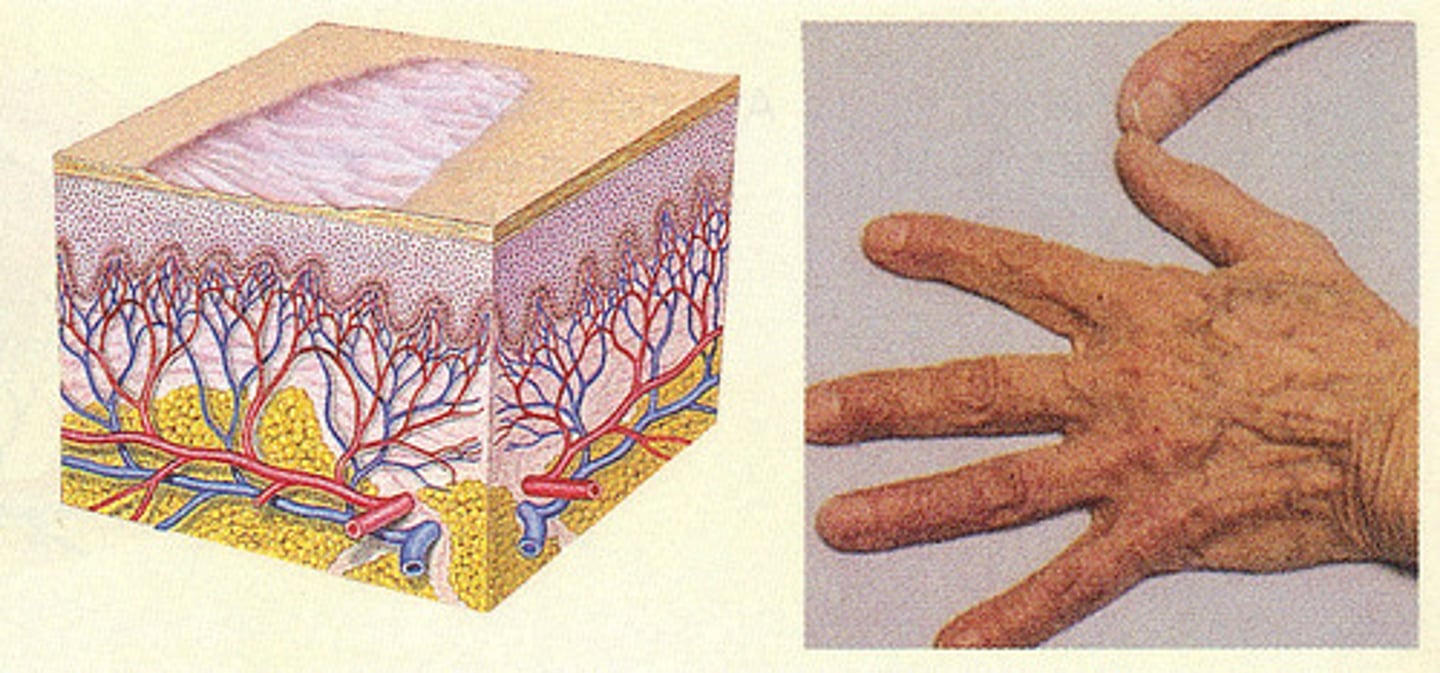 <p>thinning of the skin with the loss of normal skin furrows</p><p>Ex: seen in aging</p>