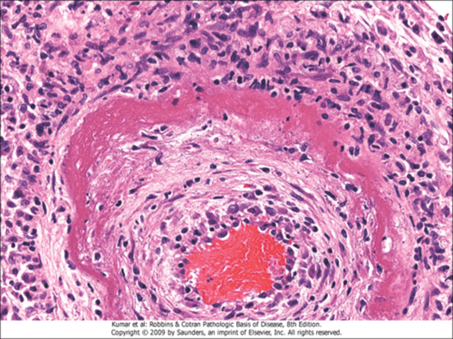<p>special form of necrosis seen in immune reaction involving blood vessels</p>