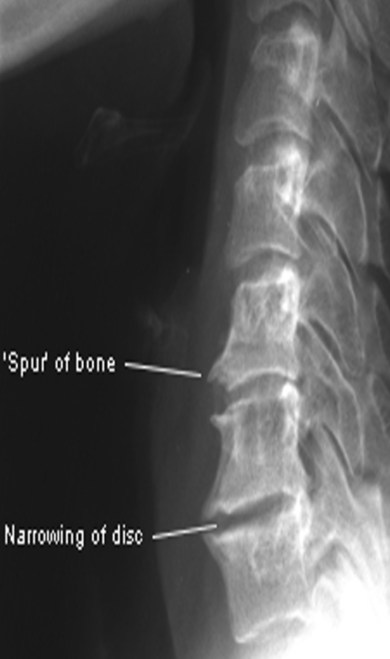 <ul><li><p>ant or post osteophytes</p></li><li><p>narrowed disc space</p></li><li><p>scoliosis, lordosis, kyphosis</p></li><li><p>MRI, CT, X-ray </p></li></ul><p></p>