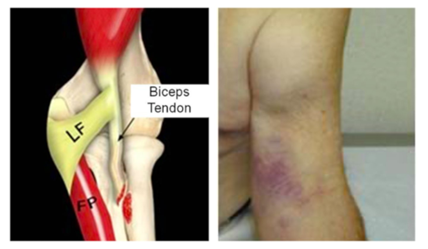 <p>biceps rupture</p><p>- will feel a pop/snap following by pain</p>