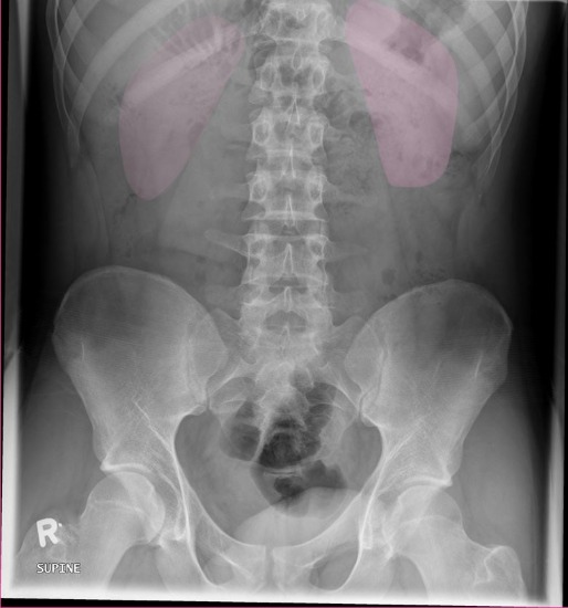 <p>Expiration; lower poles of kidneys are at the transverse processes of L3</p>