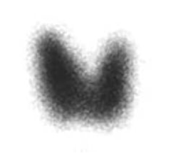 <p>what is indicated by increased uptake on radioiodine scan</p>
