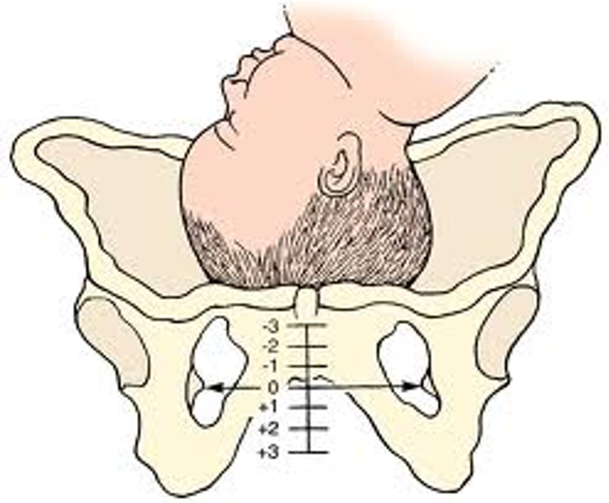 <ul><li><p>The level of descent of the presenting part of the fetus above or below the plane of the ischial spines </p></li><li><p>Ranges from -3 to +3 </p></li></ul><p></p><p></p>