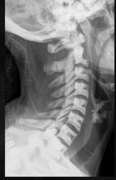 <p>what is seen here for this case of osteopetrosis?</p>