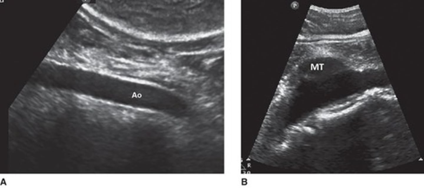 <p>A tear in the inner lining of the aortic wall, forming a false lumen.</p>