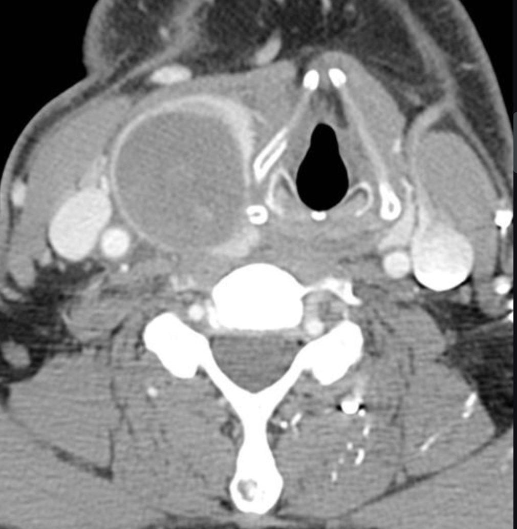 <p>What type of thyroid nodule is this - fluid filled can be simple (fluid only) OR complex (some solid parts)</p>