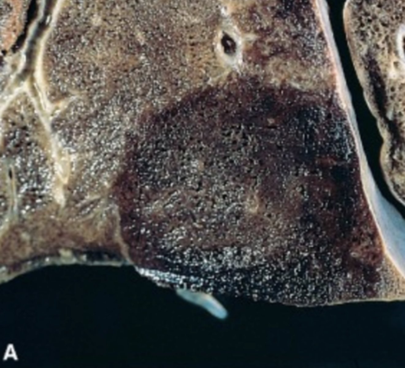 <p>- These occur with venous occlusion, in loose tissues such as the spleen and lung, and in tissues which have double circulation (i.e. lung (see image) and intestine)</p>