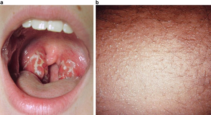 <p><span>Rhinosinusitis or atypical ENT infections (e.g., </span><em>Mycoplasma</em><span> pharyngitis)</span></p>