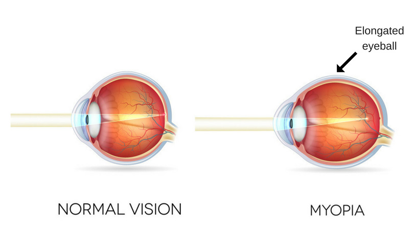 how do people with myopia see?