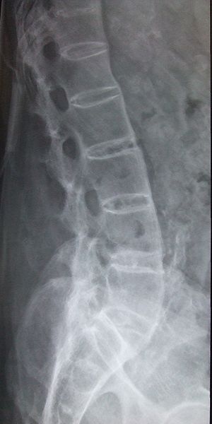 <p>Define the pathology and describe its radiographic appearance and symptoms</p>