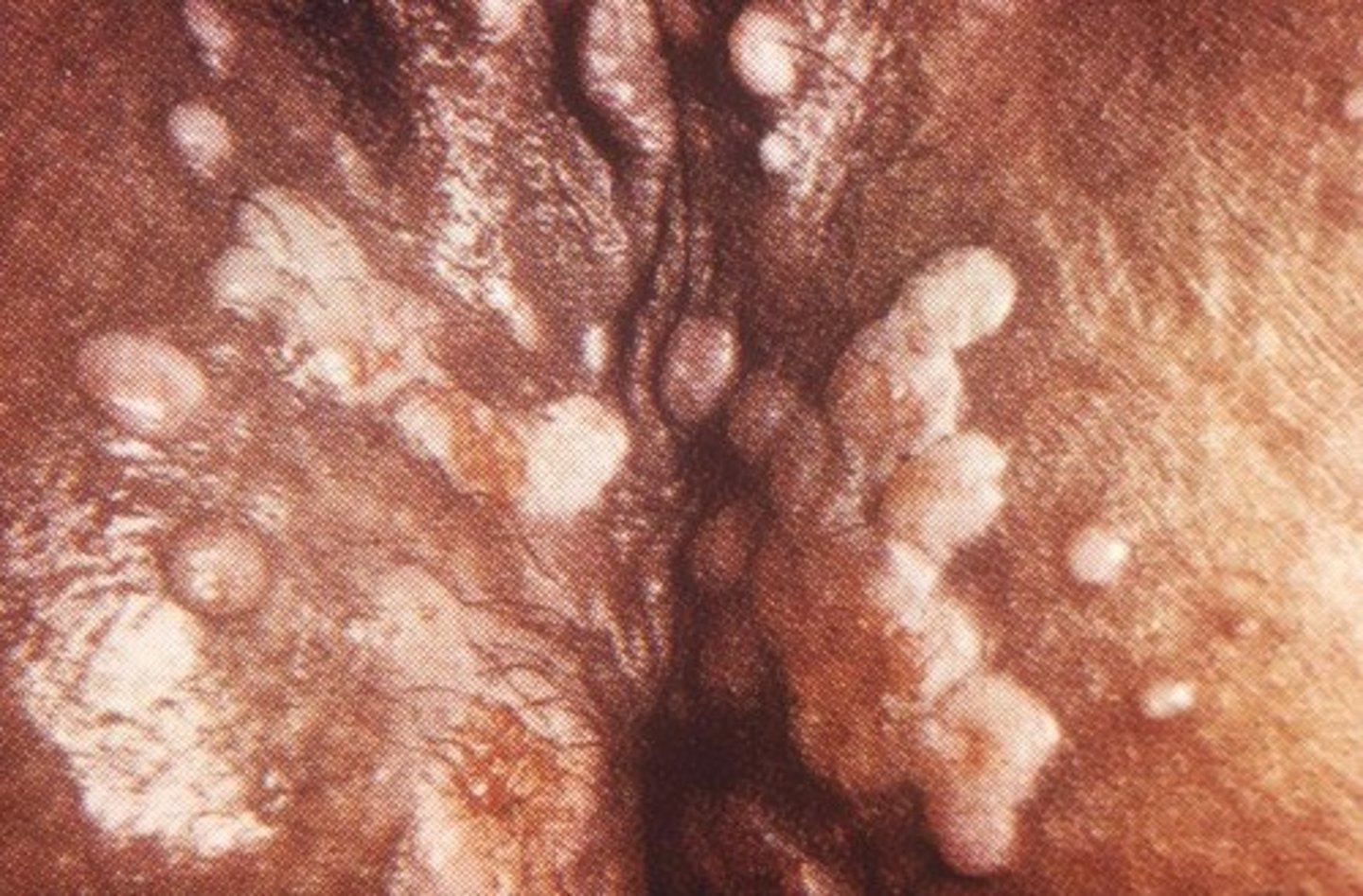 <p>These are flat lesions resembling warts that are seen most commonly in moist areas of the body.</p><p>It is seen in secondary syphilis</p>