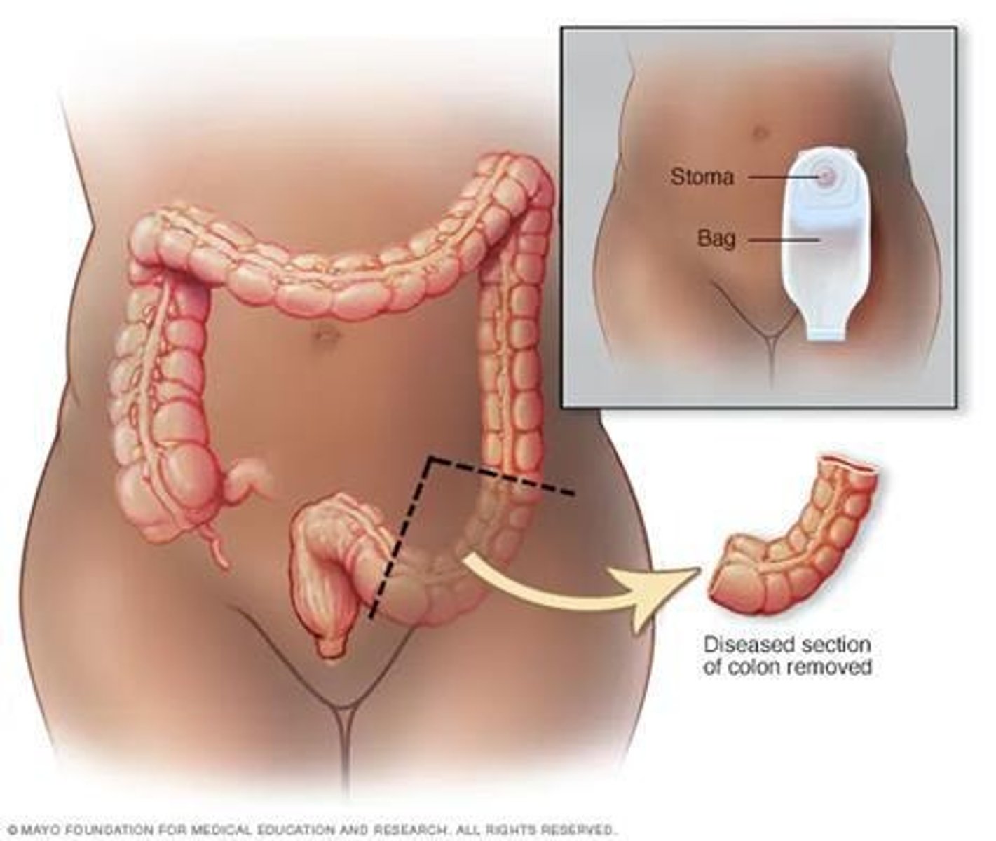 <p>Slow development, constipation, changes in stool shape, blood in stool, weakness, anorexia, abdominal distention, visible bowel loops, and crampy lower abdominal pain.</p>