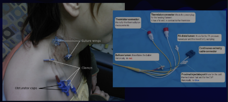 <p>a catheter is placed into the central venous system and advanced into the right side of the heart. The right atrial, right ventricular, pulmonary artery, and pulmonary artery occlusion (formerly known as pulmonary capillary wedge) pressures are measured, and cardiac output is calculated. These parameters are used to monitor the hemodynamic status of the patient and to <strong><em>calculate the pulmonary and peripheral vascular resistances.</em></strong></p>