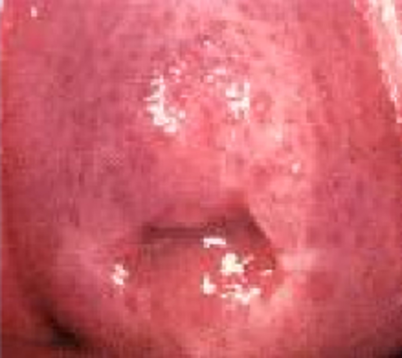 <p>Asymptomatic</p><p>Purulent malodorous thin discharge, frothy, bubbly, (green, yellow, thin)</p><p>Vaginal irritation</p><p>Dyspareunia</p><p>Dysuria</p><p>Erythema of the vulva/vagina</p><p>Punctate hemorrhages on the cervix “strawberry cervix”</p>