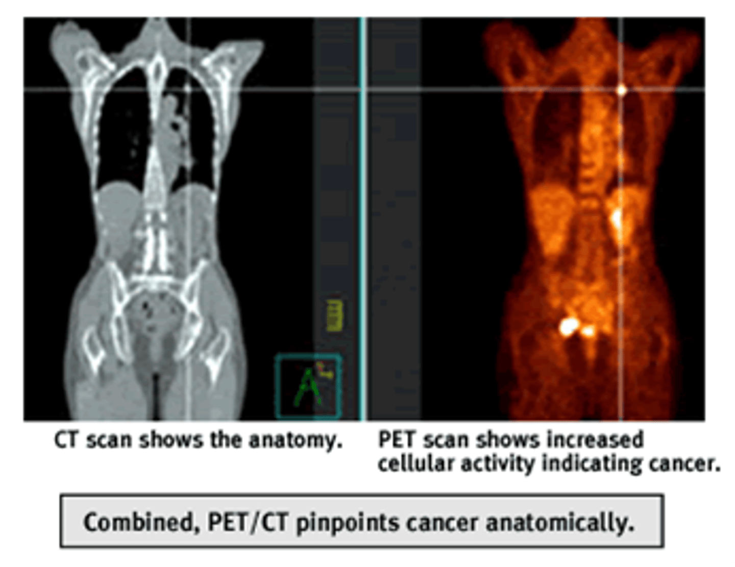 <p>-Combines PET and CT techniques to have a more accurate image</p><p>-Used with surgical planning, radiation therapy, and cancer staging</p>