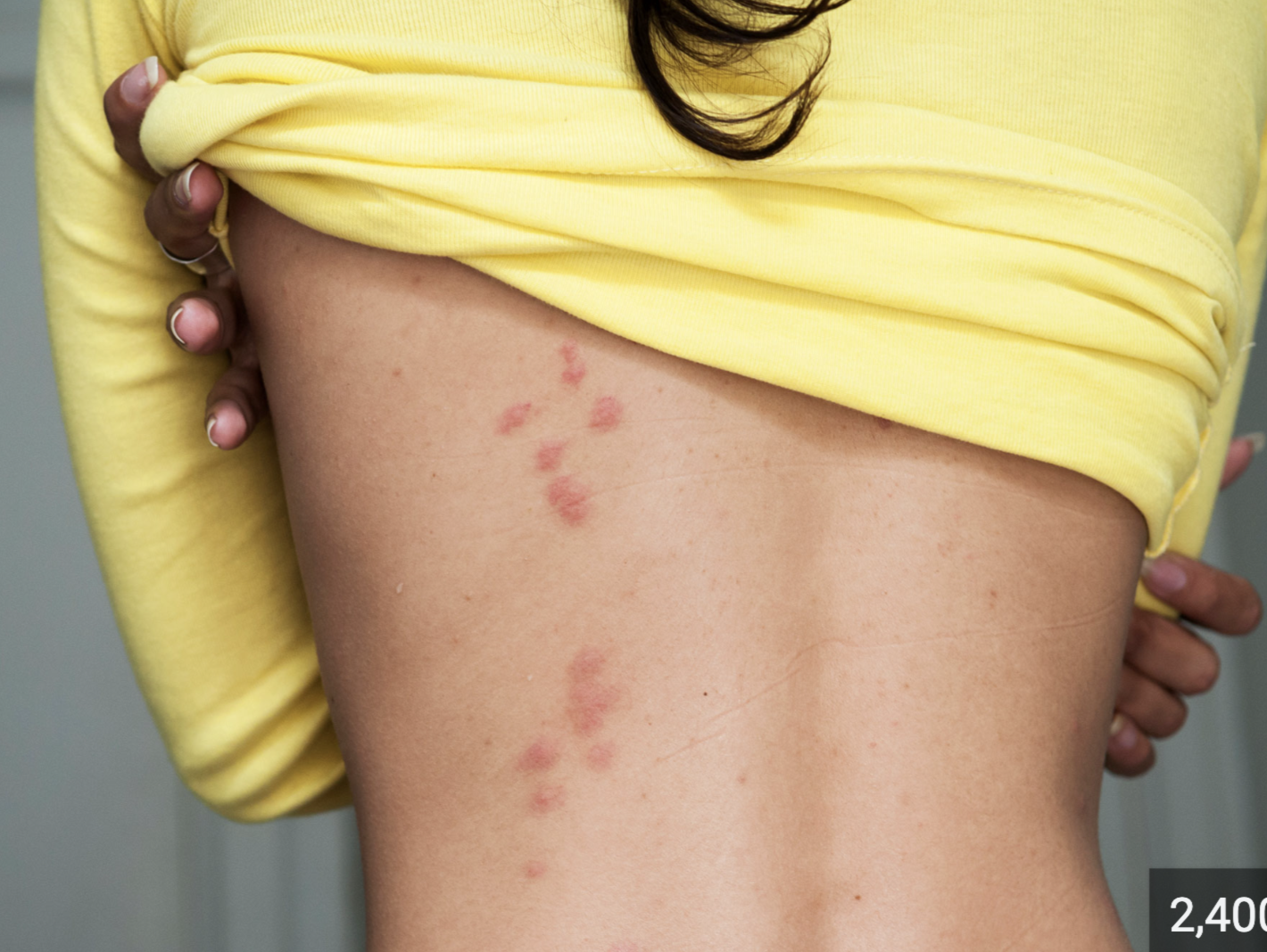 <p>usually hide and deposit eggs into crevices of walls, floors, beddings, and furniture</p><ul><li><p>become active at night</p></li><li><p>irritation at site of bite </p></li><li><p>dermal hemorrhage</p></li><li><p>multiple bites in a line</p></li></ul><p></p>