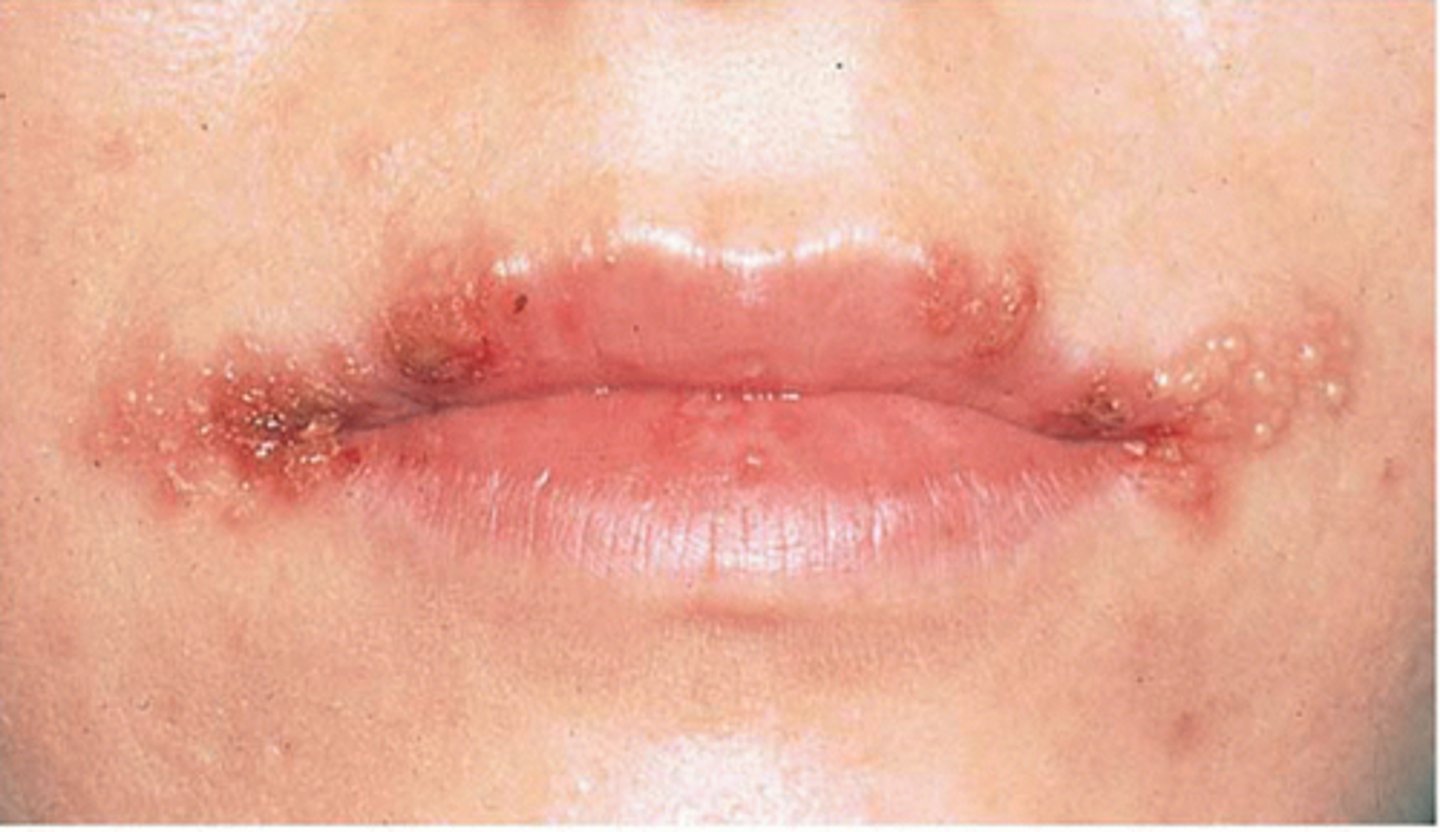 <p>Initial infection: primary herpetic gingivostomatitis- painful, red, multiple vesicles progressing to ulcers</p><p>Systemic problems include malaise, fever, lymphadenopathy</p><p>Common in young children</p><p>May cause trigeminal ganglion</p><p>Herpes labialis: found on lip border recurrent cold sores, fever blisters-vesicles will ulcerte</p><p>May cause tingling, itching, burning and redness prior to lesion approaching</p><p>Triggers: stress, sun exposure, fever, menstruation; especially Problematic for immunocompromised clients</p><p>Recurrent intraoral HSV: "bound-down" keratinized mucosa (hard palate and attached gingiva)</p><p>Healing in 7-10 days</p><p>Treatment: Acyclovir or antiviral creams</p>