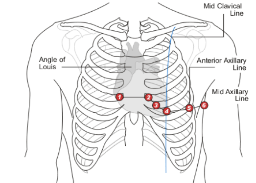 <p>Which precordial lead is found in the <strong>5th</strong> intercostal space aligned with the <strong>midclavicular line</strong>?</p>
