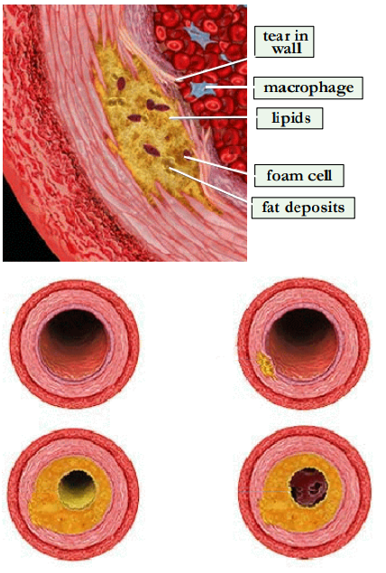 <p>Buildup of fats, cholesterol and other substances in and on the artery walls</p>