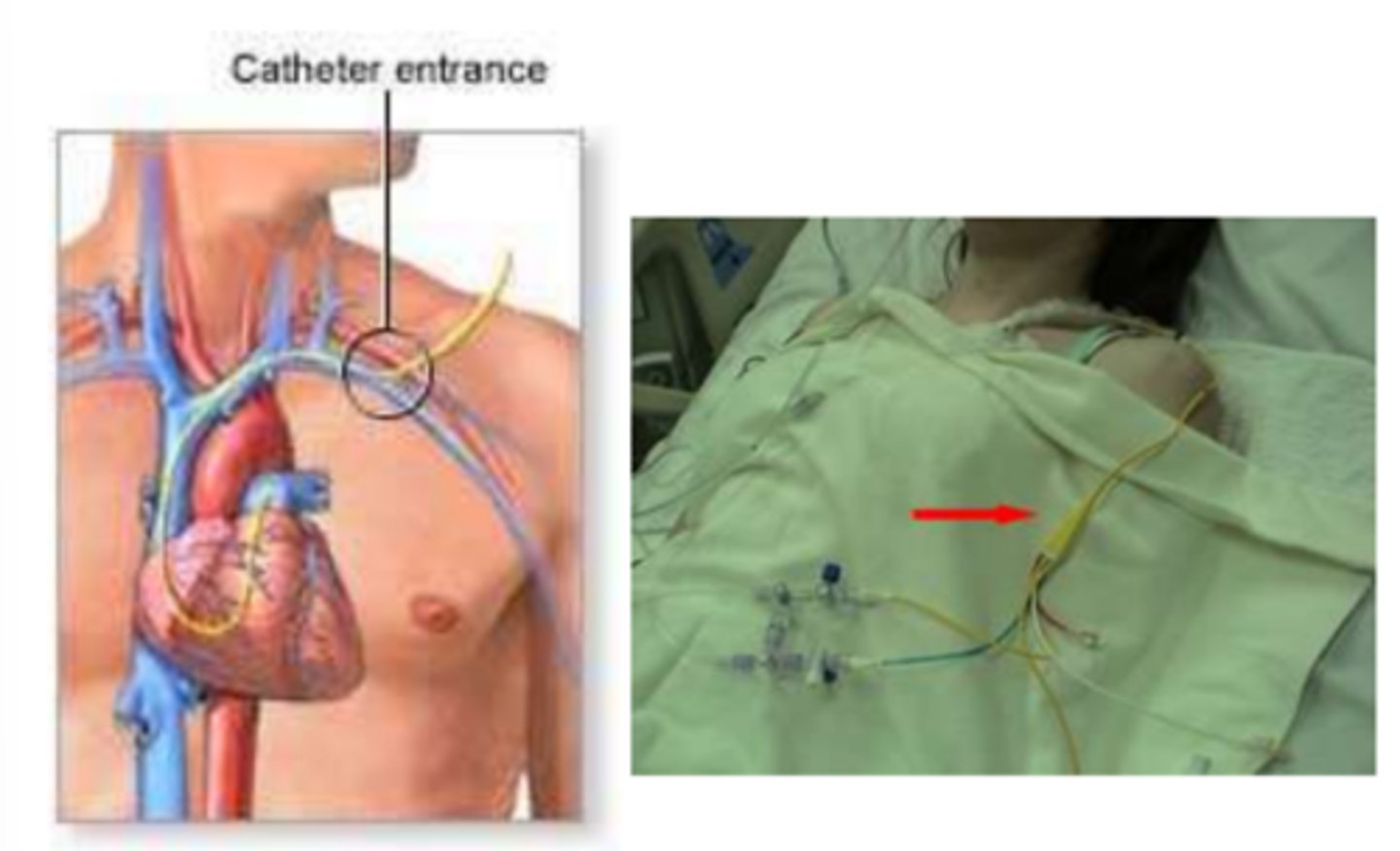 <p>Measures intra-cardiac pressures.</p>