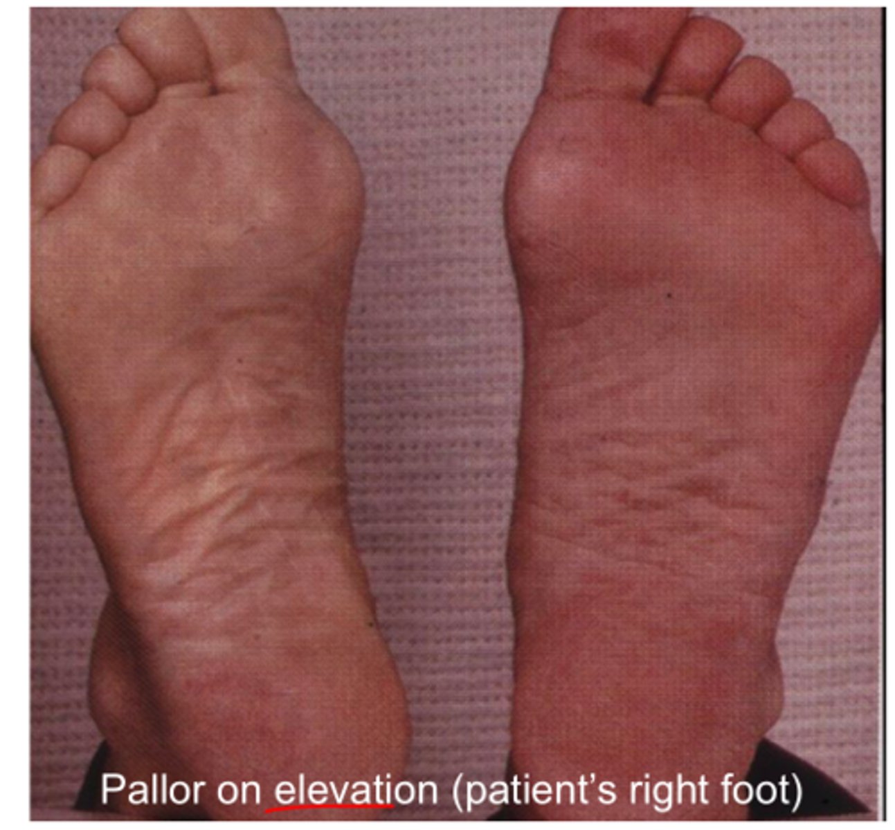 <p>-hairless</p><p>-cold/pale extremities</p><p>-slow healing ulcers</p><p>-pallor on elevation and cyanosis on nail bed</p><p>-thin shiny skin</p><p>-intermittent claudification relieved with rest</p><p>-weak/absent pulses</p><p>-paresthesia (tingling sensation)</p>
