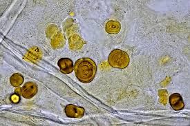 <ul><li><p>yellow-brown spheres</p></li><li><p>rare</p></li><li><p>associated with severe liver disease </p></li></ul><p></p>