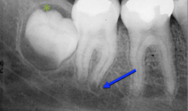 <p><strong>Normal Anatomy</strong></p>