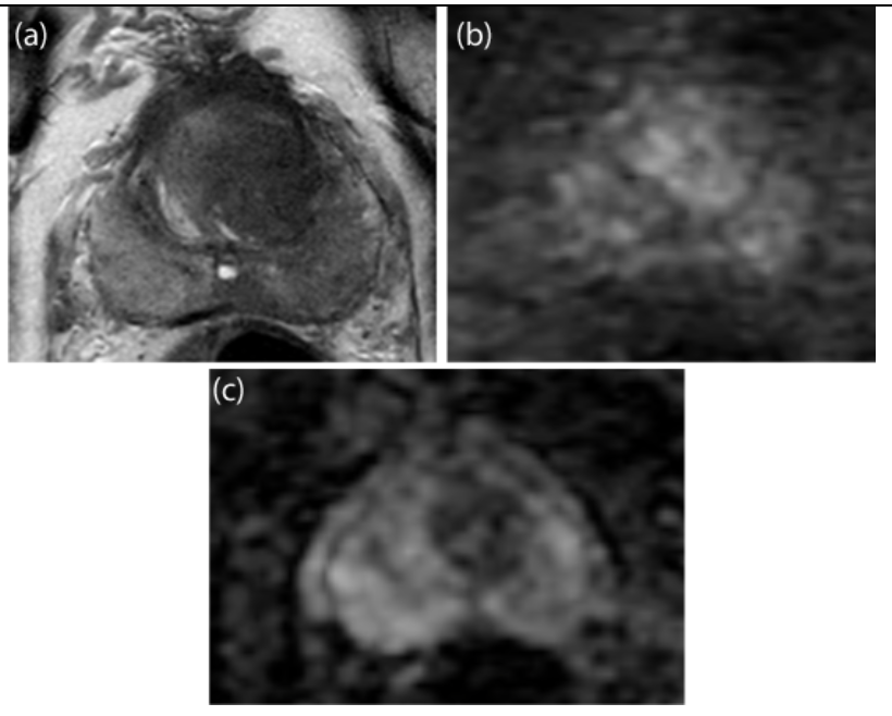 <p>Describe the lesions in a) T2 imaging b) DWI c) ADC</p>