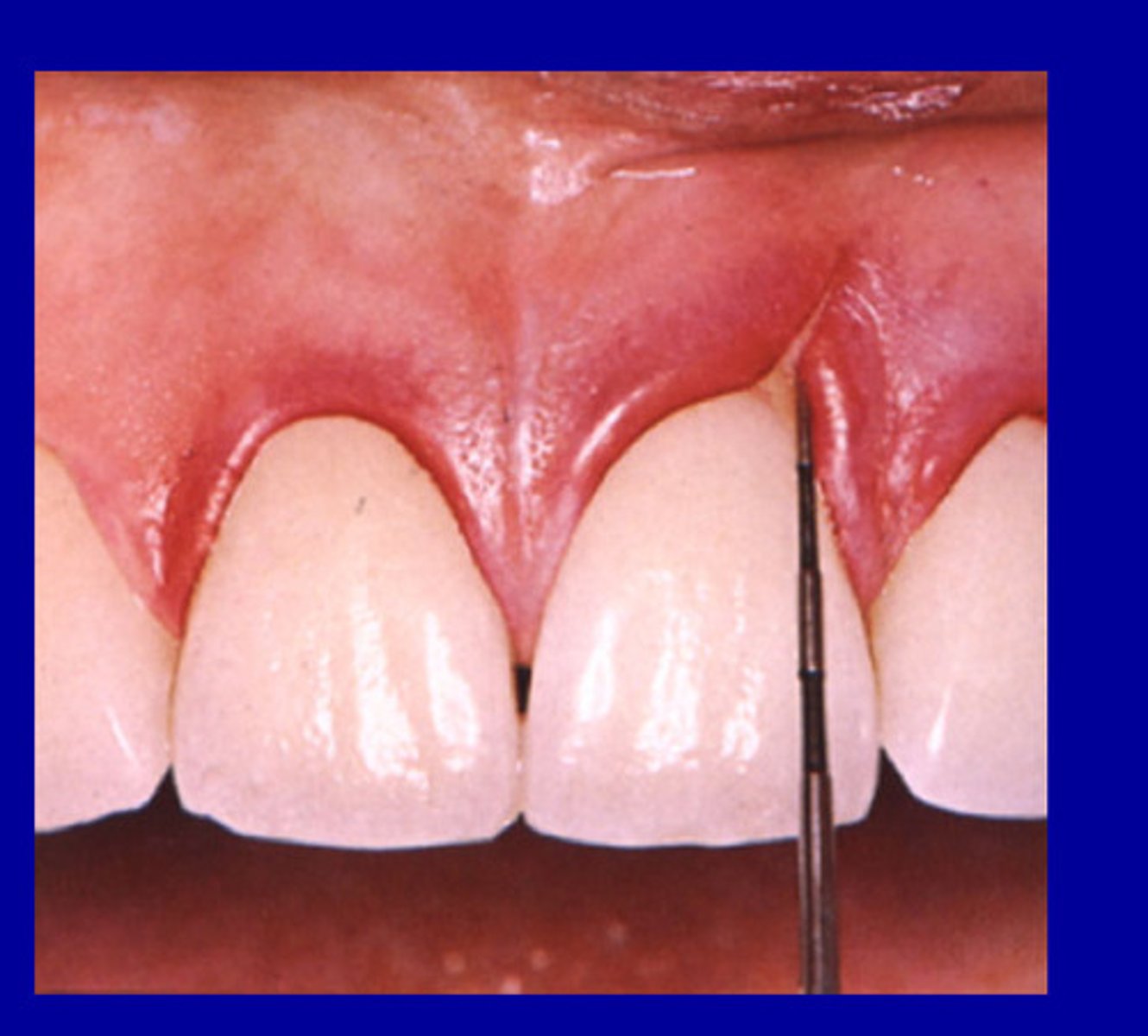 <p>Lack of oxygen can lead to receding, openings, cracks due to inflammation, etc</p>