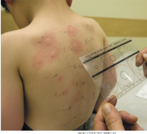 <p>Intradermal injection or scratch of liquid  \n allergen; formation of a wheal in response to the allergen is indicative of allergy.</p>