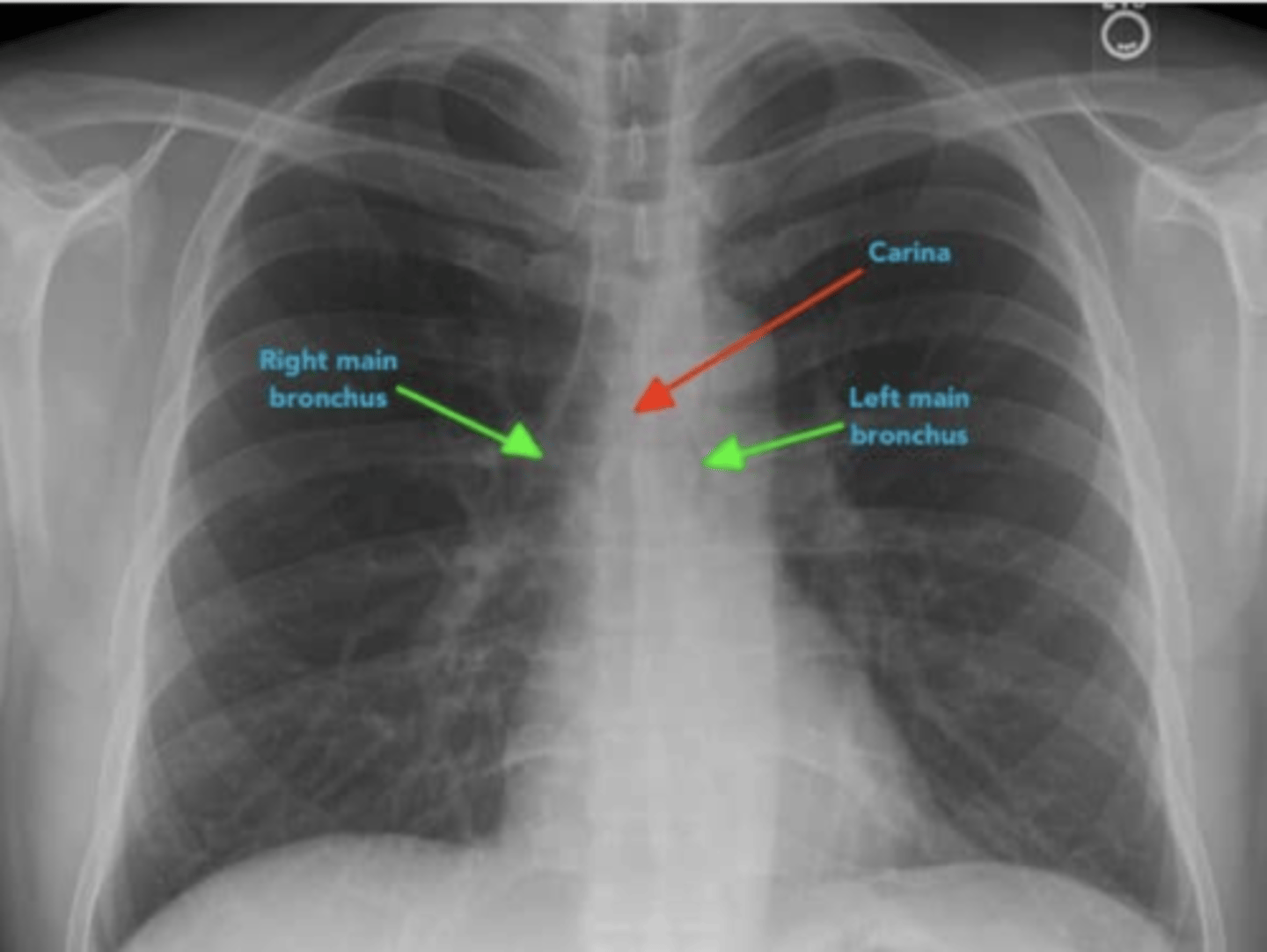 <p>1.Carina and bronchi</p><p>⚬The carina is cartilage situated at the point at which the trachea divides into the left and right main bronchus.</p><p>•On appropriately exposed chest X-ray, this division should be clearly visible.</p><p>•The carina is an important landmark when assessing nasogastric (NG) tube placement, as the NG tube should bisect the carina if it is correctly placed in the gastrointestinal tract.</p><p>2. The right main bronchus is wider, shorter and more vertical than the left main bronchus.</p><p>•As a result of this difference in size and orientation, it is more common for inhaled foreign objects to become lodged in the right main bronchus.</p>