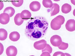 <p>B. Giant lysosomal granules</p><p>Chédiak-Higashi syndrome is a disorder of neutrophil phagocytic dysfunction caused by depressed chemotaxis and delayed degranulation. The degranulation disturbance is attributed to interference from the giant lysosomal granules characteristic of this disorder.</p>