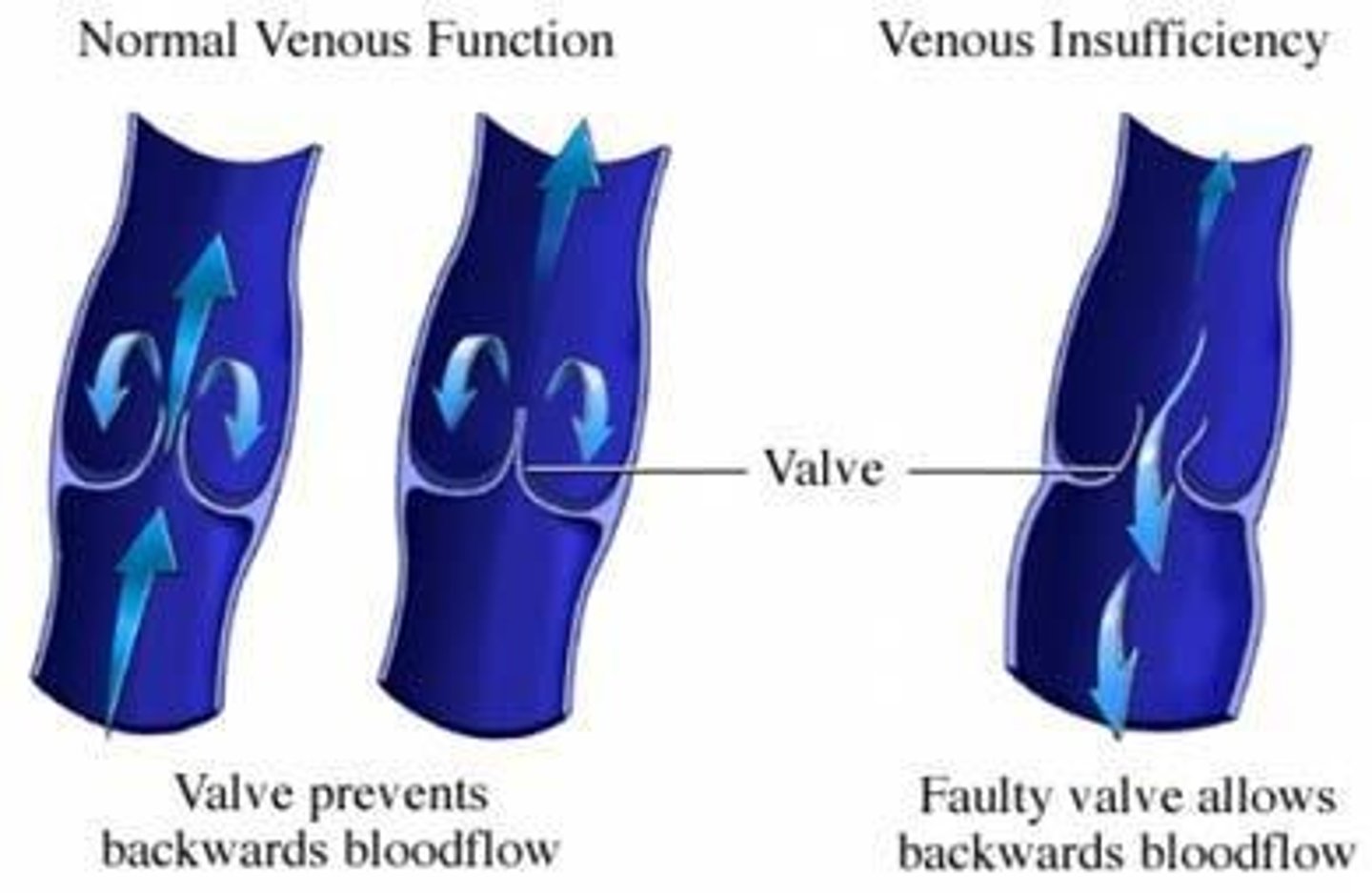 <p>Formation of a clot in a vein resulting in inflammation</p><p>Sxs - Same as DVT</p><p>Risk factors - Same as DVT</p><p>Difference from DVT = Different vein; saphenous veins</p><p>Self limiting</p>