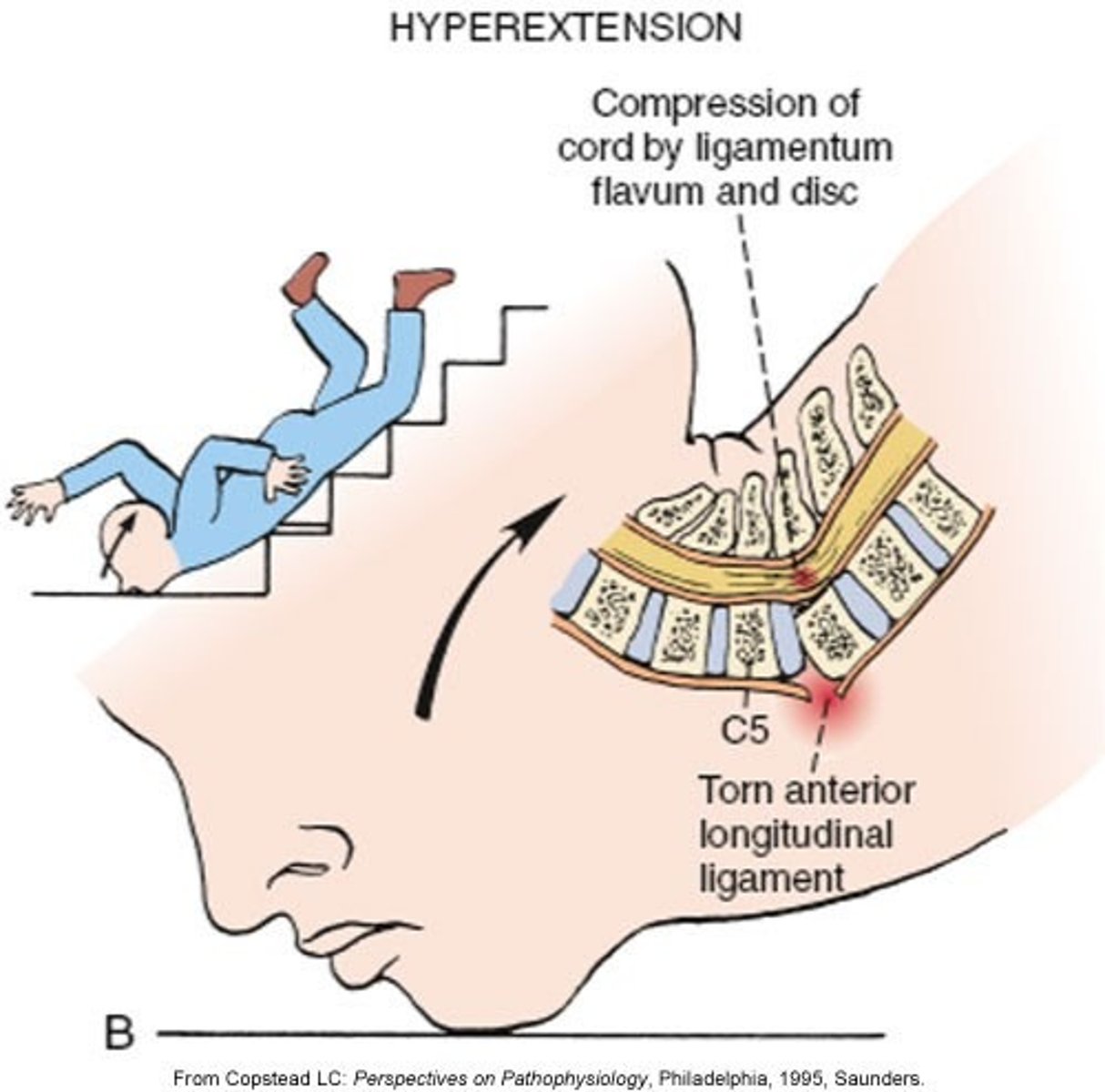 <p>hyperextension (primary injury)</p>