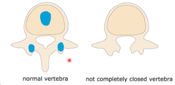 <p><strong><span>vertebral arch defect (</span></strong><span>may be said to be an NTD but is incorrect</span><strong><span>)</span></strong></p><p>1 to 2/1000 live births world-wide</p><p>Failure of fusion of two vertebral arches</p>