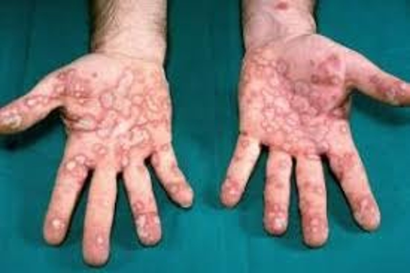 <p>target lesions with mucocutaneous involvement, up to 10% TBSA</p>