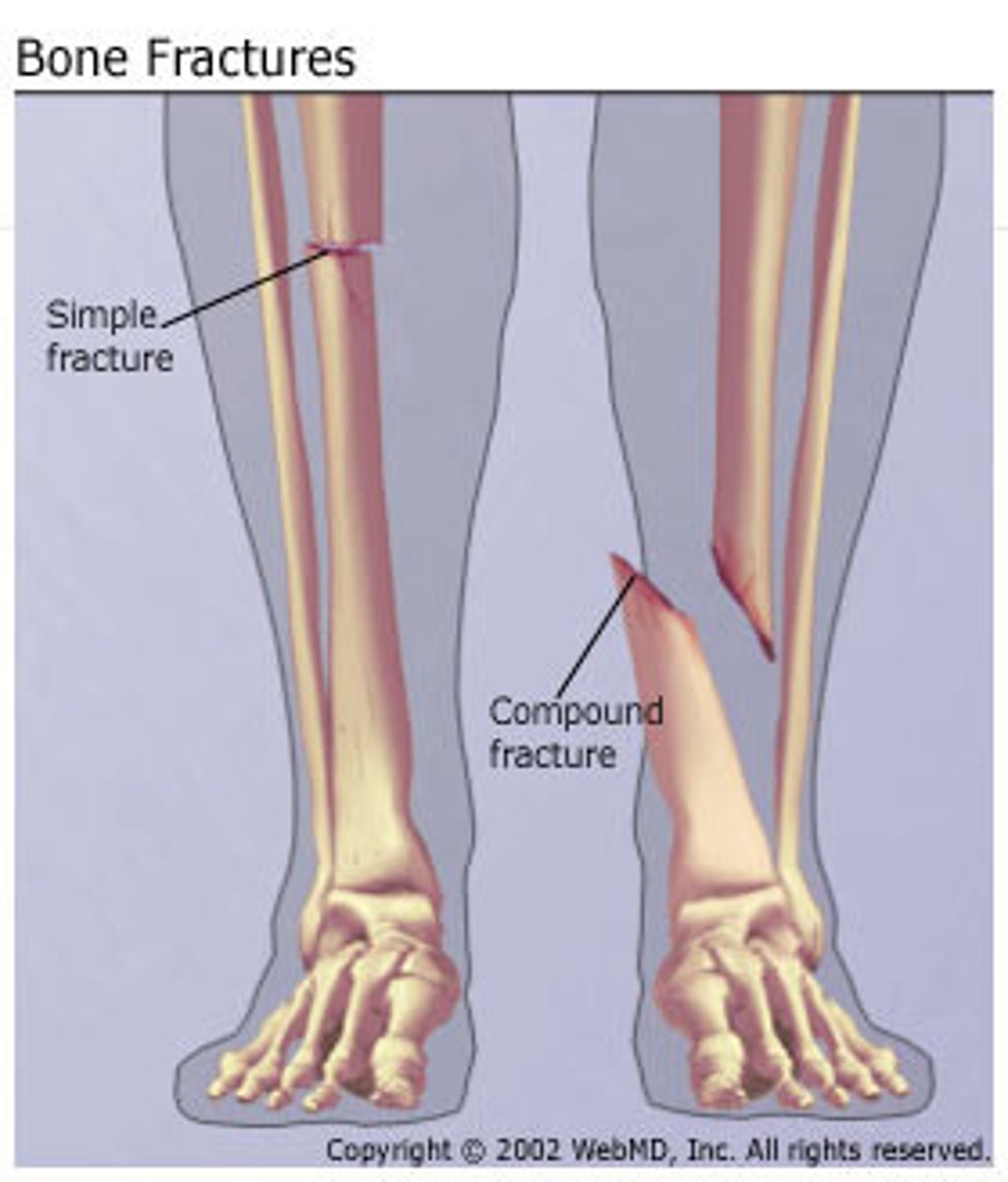 <p>bone protrudes through skin</p>