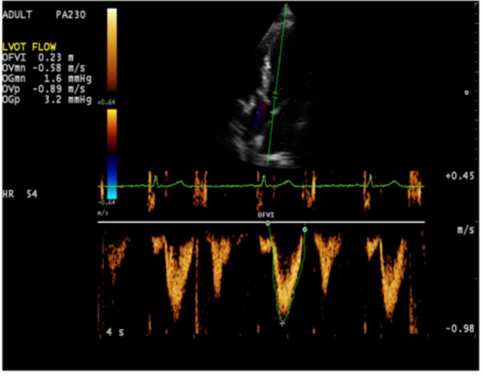 <p>Why does the Doppler tracing not touch the baseline on either side?</p><p>a. spectral broadening <br>b. decreased rejection settings<br>c. decreased Doppler gain settings <br>d. high filter settings</p>