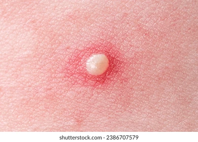<p>Small, raised, pus filled lesion </p>