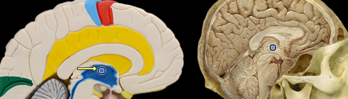 <p>Interthalamic adhesion</p>