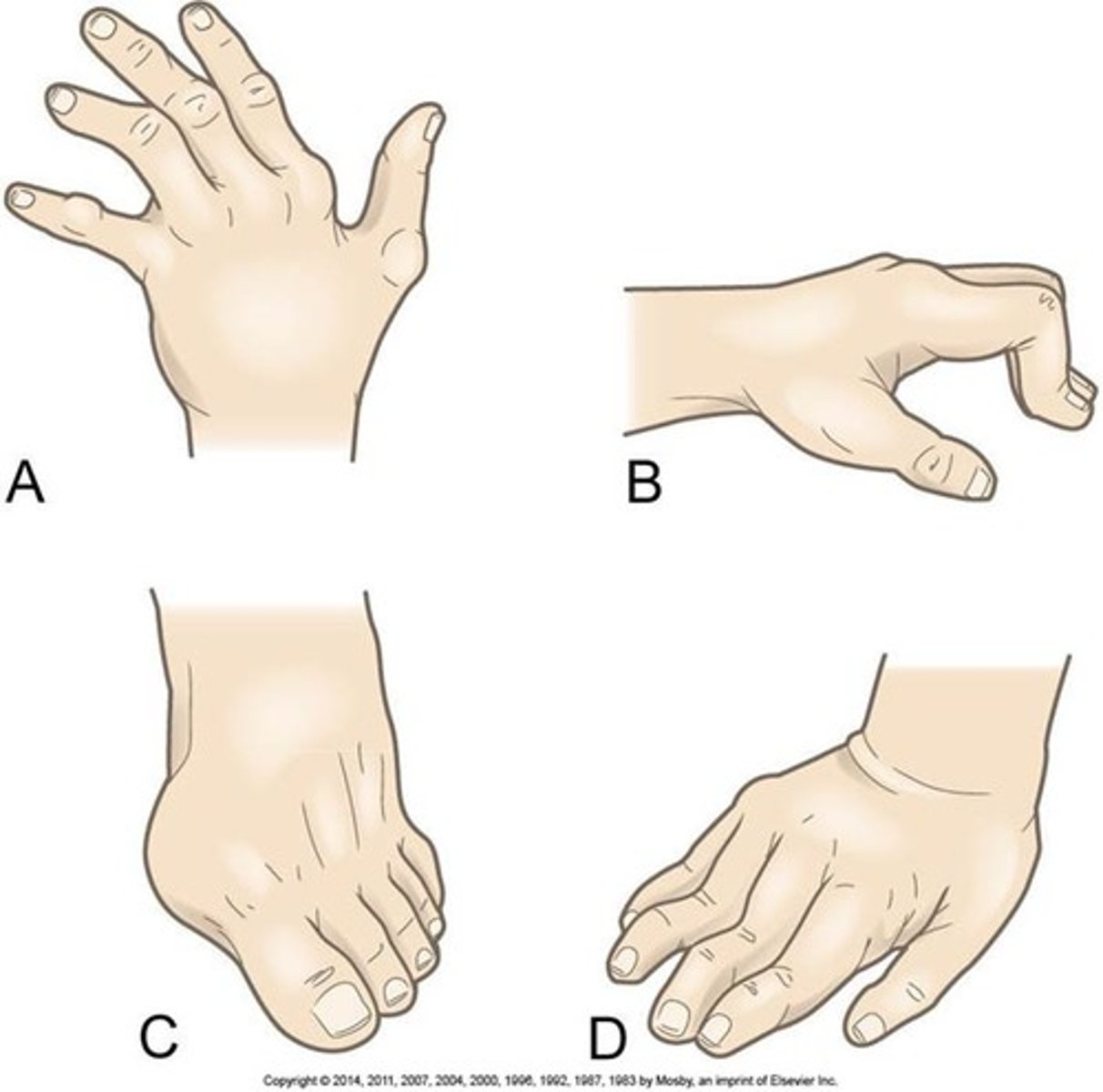 <p>Ulnar drift</p><p>Boutonniere's deformity</p><p>Hallux valgus and bunion</p><p>swan neck deformity</p><p>Hammer Toes</p><p>Rheumatoid nodules</p>