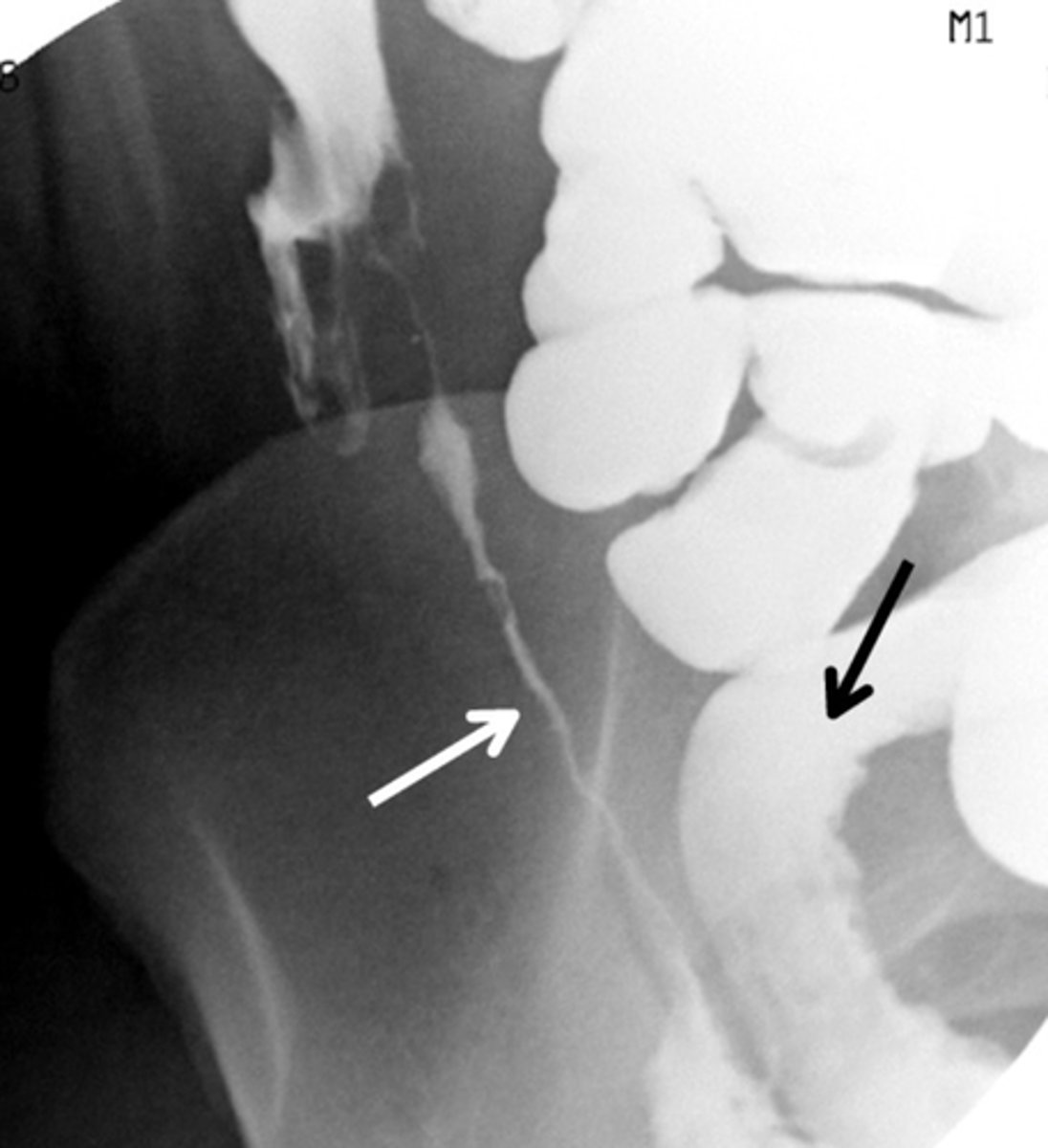 <p>Crohn disease is associated with the string sign or narrowing of the bowel lumen on X-ray</p>