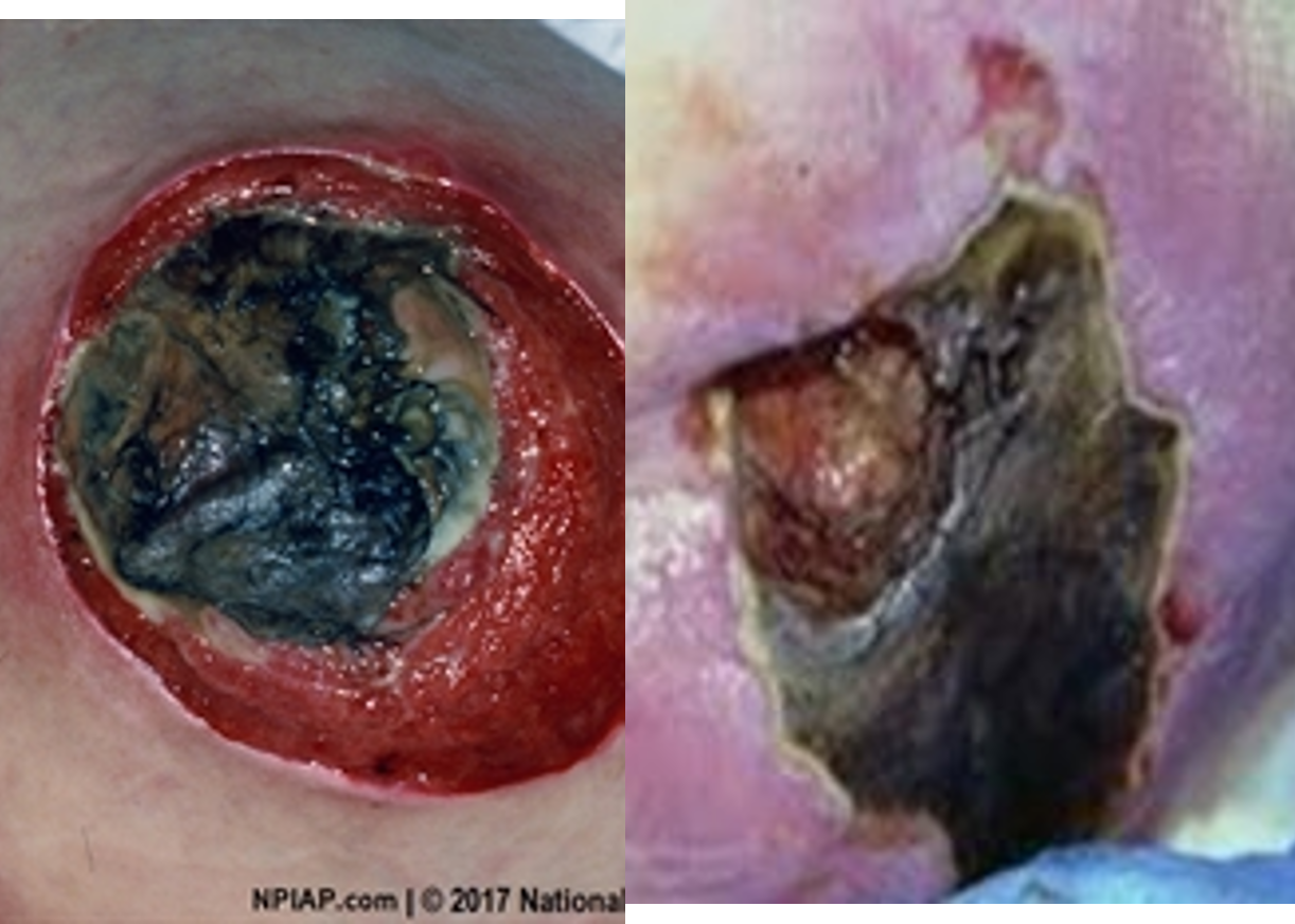 <p><strong>What stage pressure injury?</strong></p><ul><li><p>localized areas of tissue necrosis covered with slough (viscous fibrinous dead tissue that is yellowish) or eschar (dead tissue that is dry, dark scab)</p></li><li><p>base of ulcer not visible &amp; can’t properly assess depth</p></li></ul><p></p>