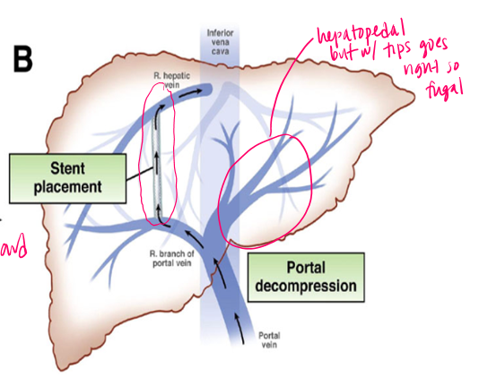 <p>a stented channel between a portal vein and hepatic vein </p><ul><li><p>typically RPV (posterior branch) and RHV</p></li></ul><p></p>