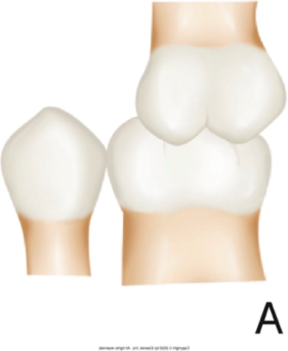 <p>ID the occlusion classification:</p>
