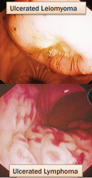 <p>Gastric Neoplasia</p>