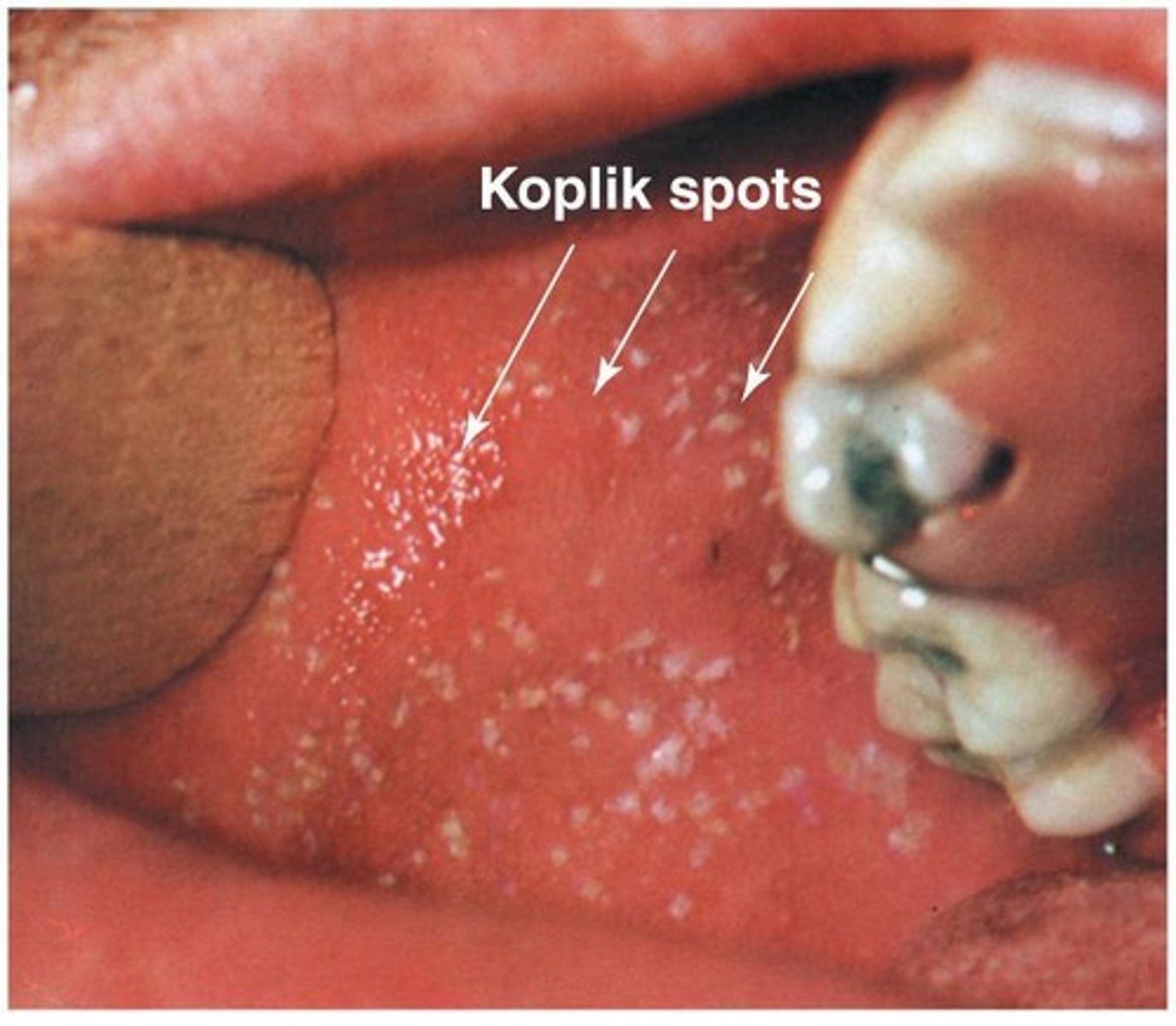 <p>An indicative sign of measles infection that appears as tiny erythematous macules with white necrotic centers on the buccal mucosa</p>